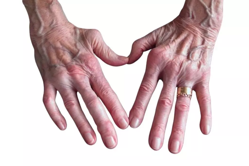 hydrogen water rheumatoid arthritis